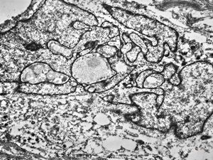 M,10y. | leiomyosarcoma M,10y. | leiomyosarcoma